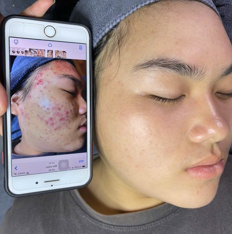 Combo trị mụn chuyên sâu