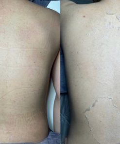 dieu-tri-mun-lung