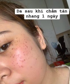 Trị tàn nhang