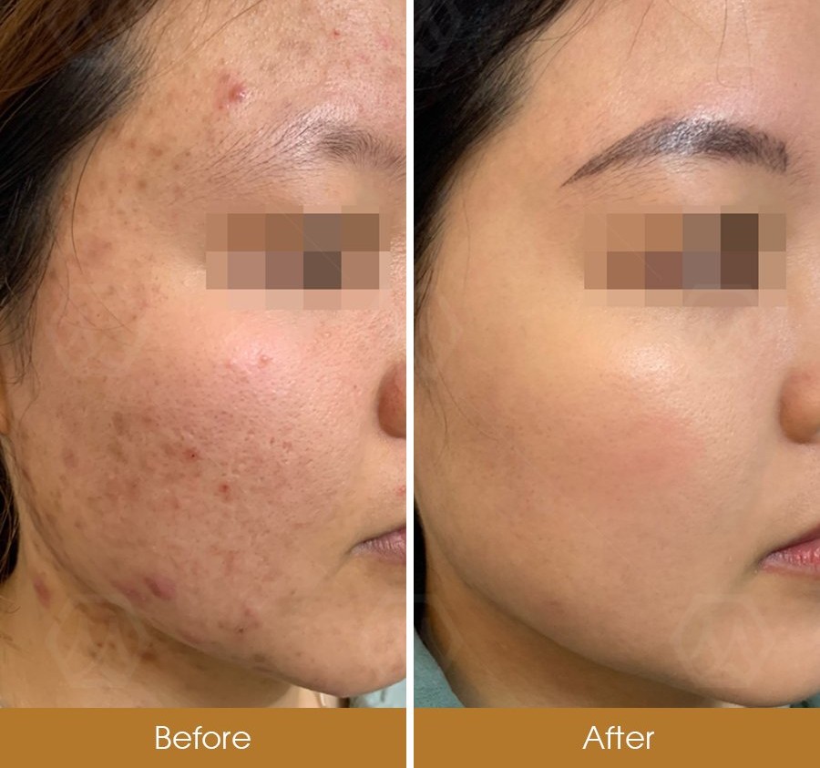 Điều trị mụn chuẩn y khoa