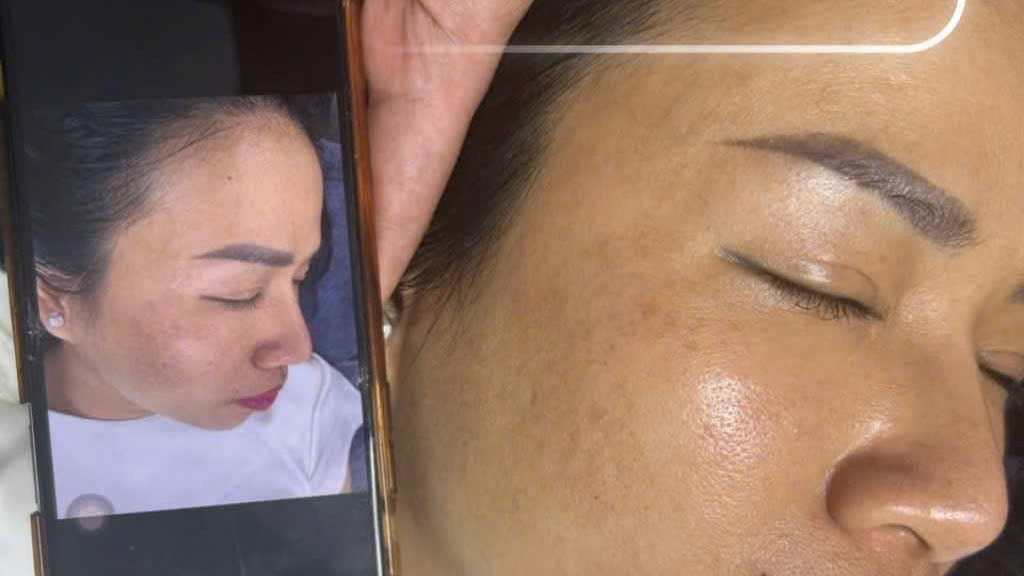Phương Pháp Trị Nám Đinh Hiệu Quả Tận Gốc Bằng Công Nghệ Cao