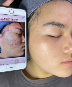 Combo trị mụn chuyên sâu