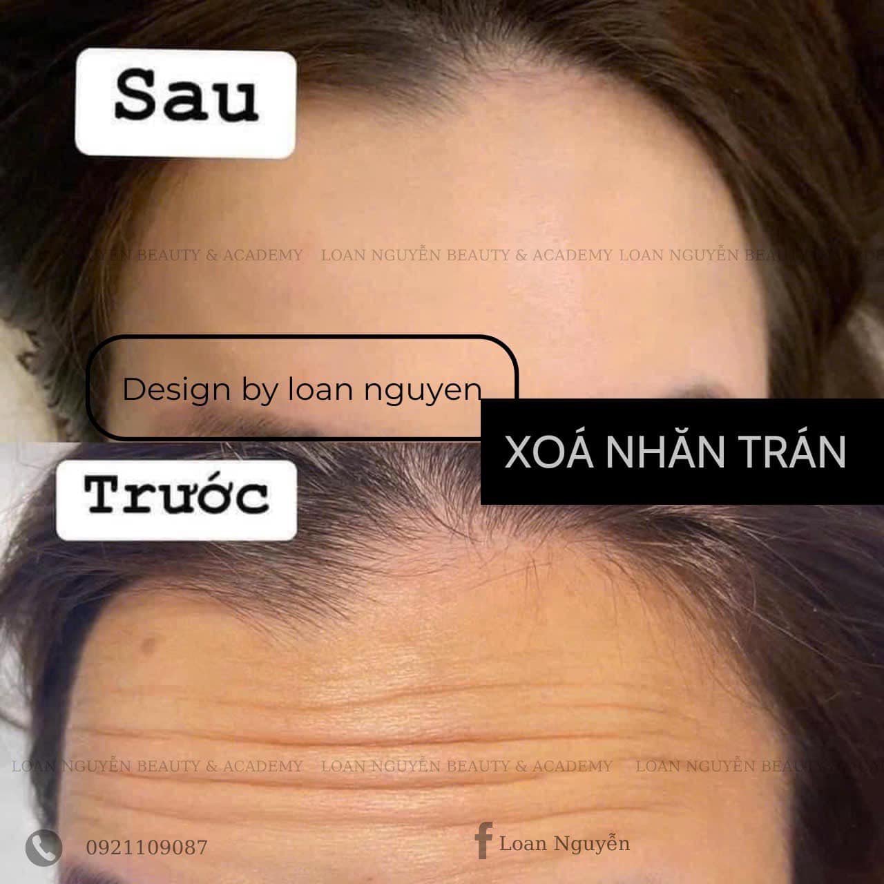 BAP nâng cơ - trẻ hóa - Image 2
