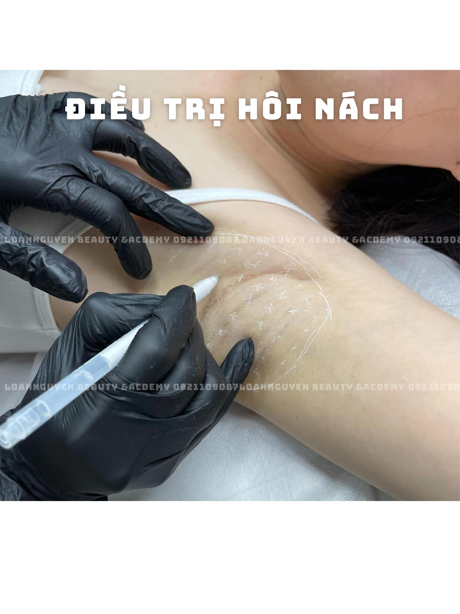 Điều trị hôi nách - Image 3