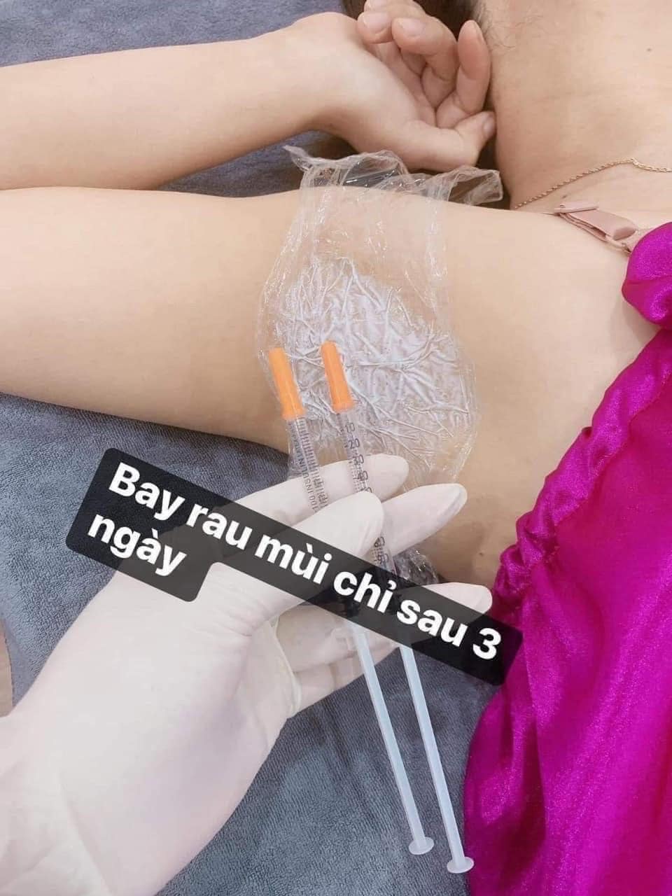 Điều trị hôi nách - Image 2