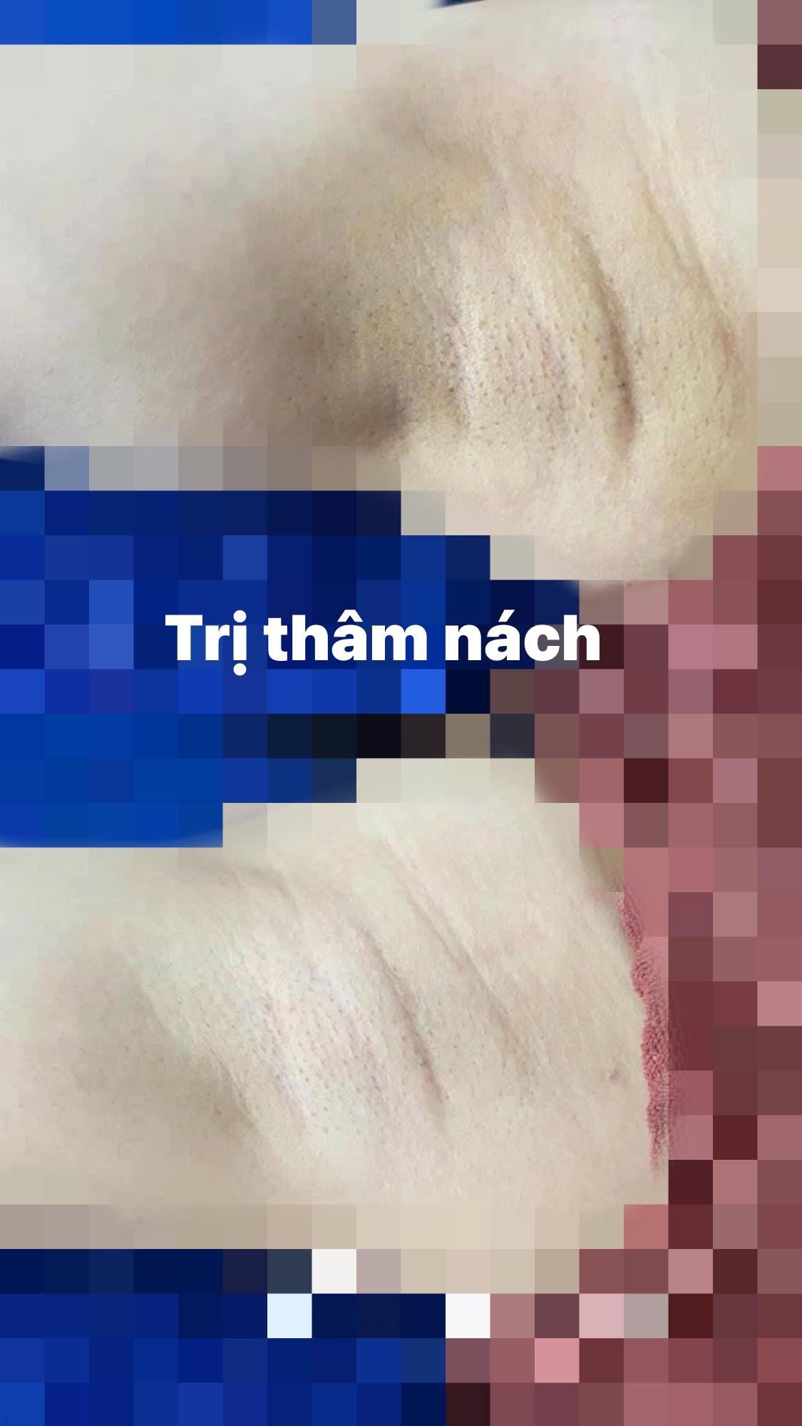 Khử thâm bẹn, mông, nách - Image 2