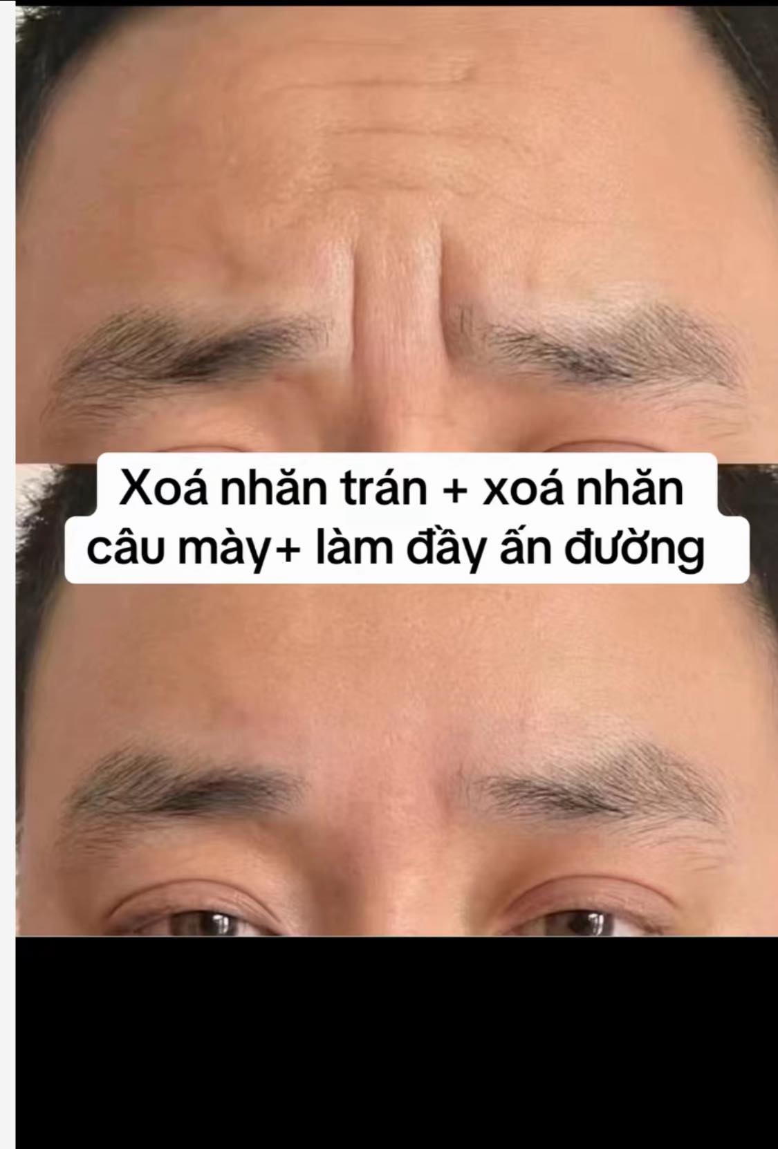BAP nâng cơ - trẻ hóa - Image 3