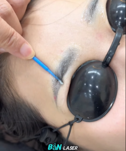 Laser Xóa Mày