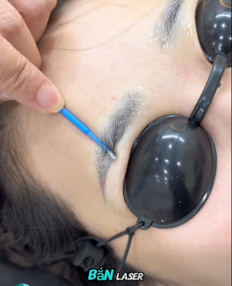 Laser Xóa Mày