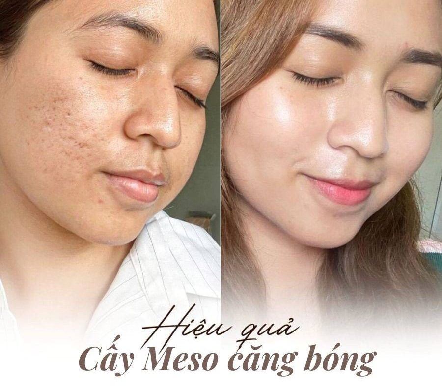 meso-cang-bong