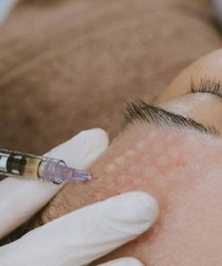 Tác dụng của tiêm meso và kỹ thuật cấy meso