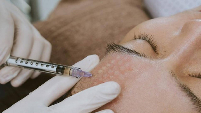 Tác dụng của tiêm meso và kỹ thuật cấy meso