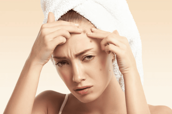 Tự nặn mụn ở nhà gây sưng viêm và lây lan