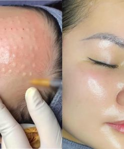 Tác dụng của tiêm meso và kỹ thuật cấy meso